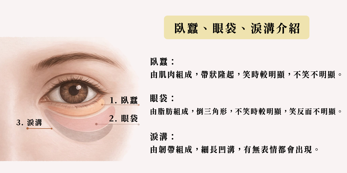 臥蠶、眼袋、淚溝位置與差異圖解：介紹肌肉組成的臥蠶、脂肪組成的眼袋與韌帶組成的淚溝。